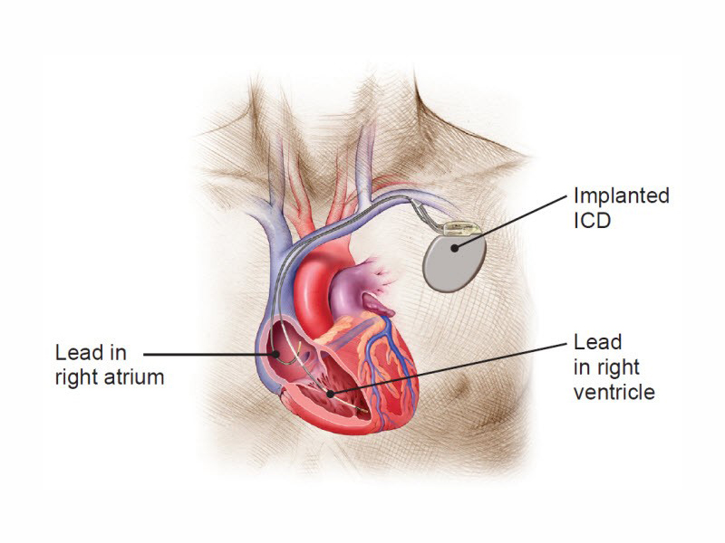ICD Implantation Hariharan Diabetes & Heart Care Hospitals (P) Ltd.